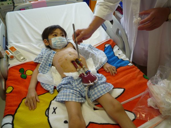 子ども用の補助人工心臓の管（カニューレ）が、体の外の血液ポンプとつながっています＝父・慎也さん提供